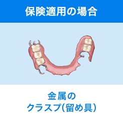 保険適用の場合 金属のクラスプ（留め具）